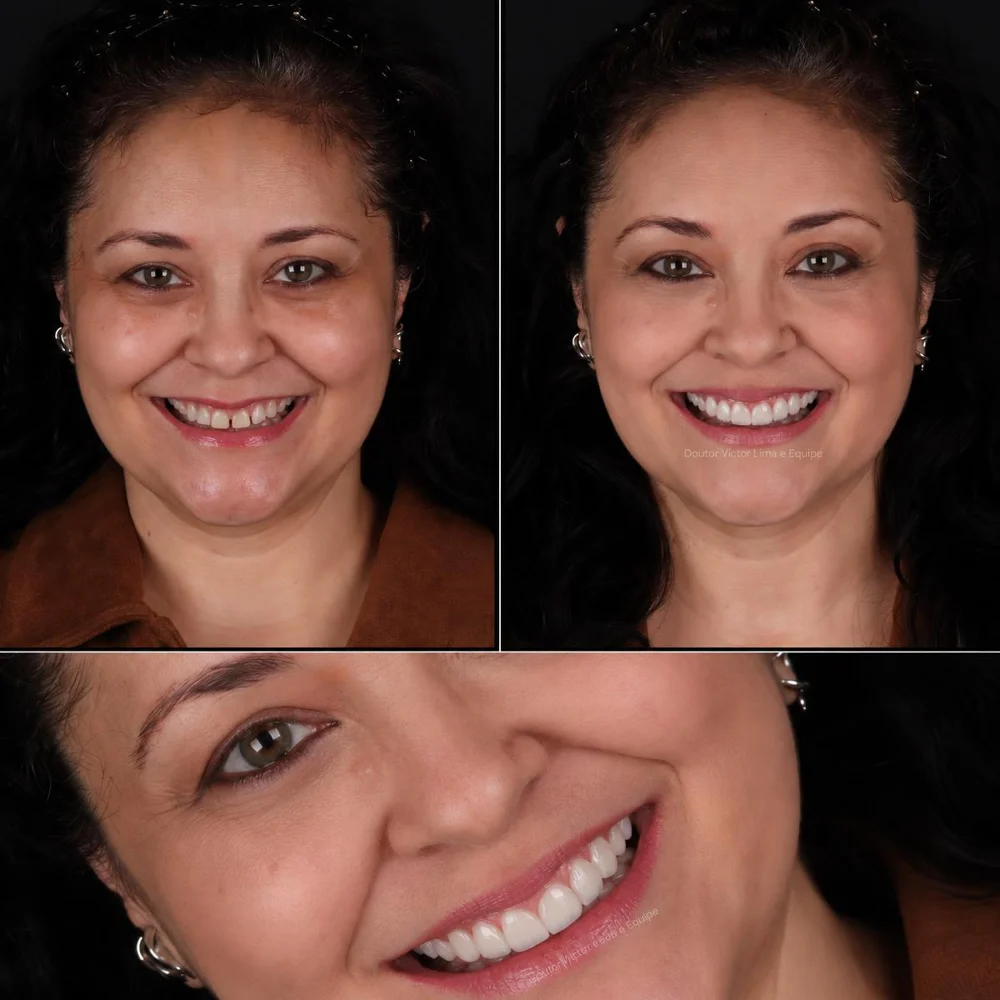 Antes e depois — paciente 2, rosto e detalhe do sorriso