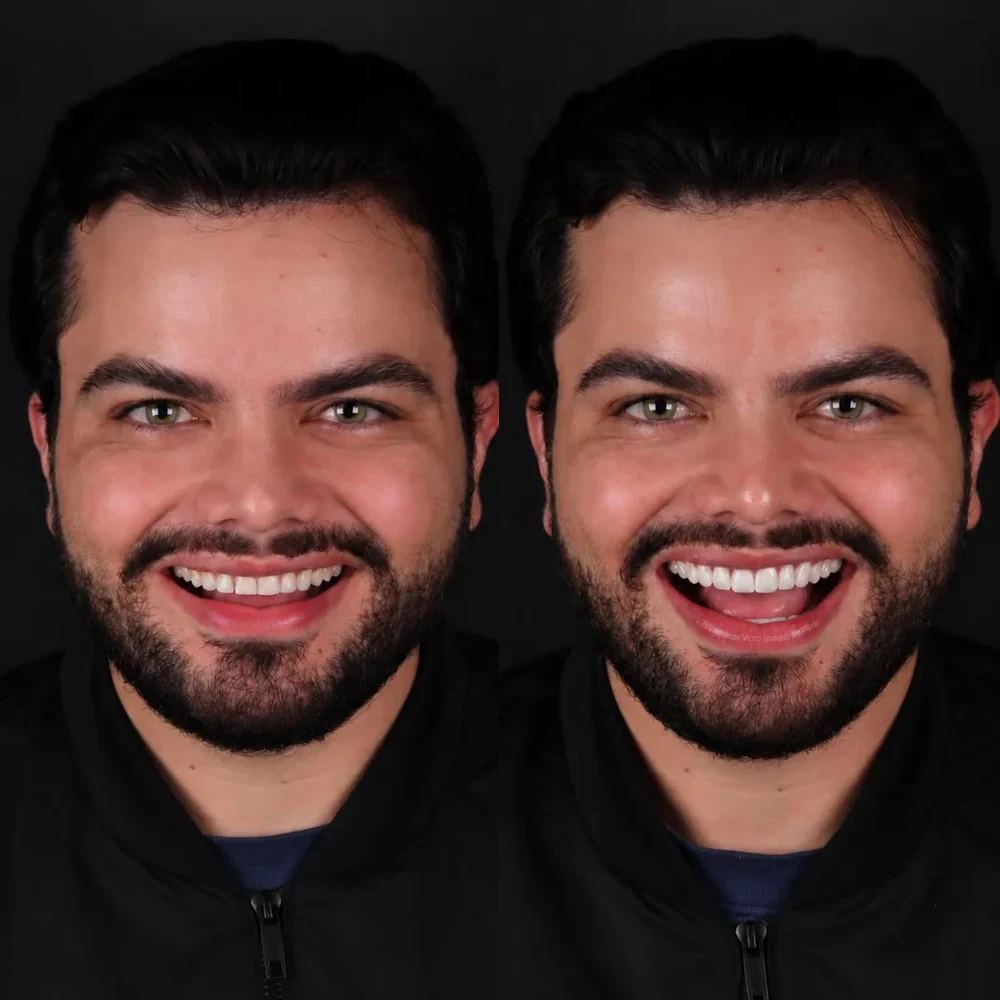 Antes e depois — paciente 3, fotografias de rosto