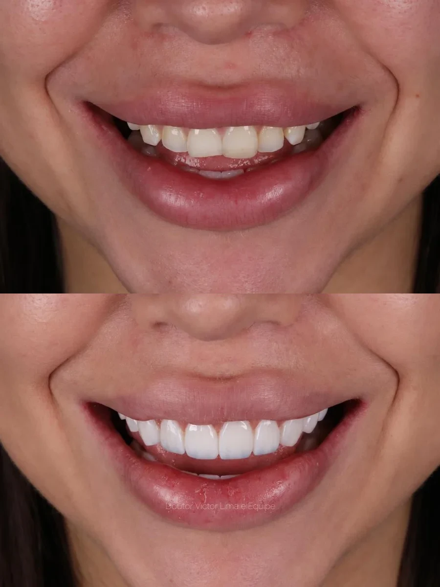 Antes e depois — paciente 1, fotografias intraorais