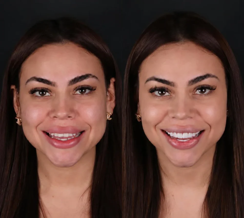 Antes e depois — paciente 1, fotografias de rosto